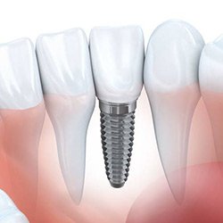Zubní implantáty zvýší sebevědomí